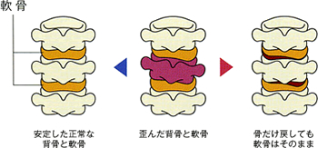 歪みのある部位